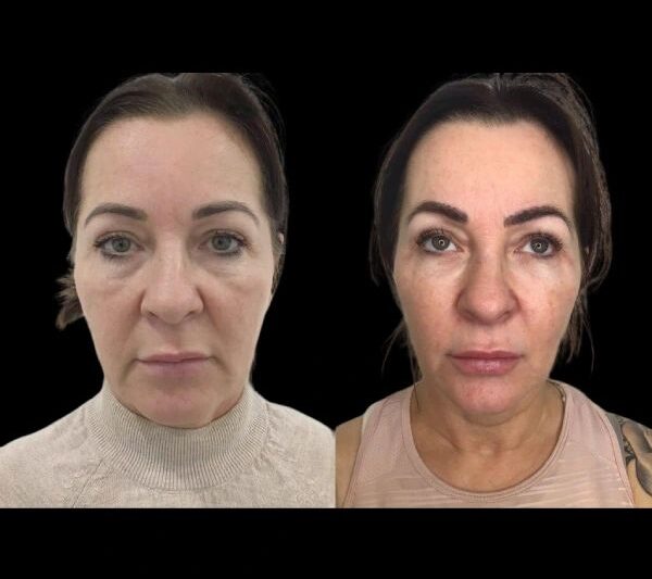 How Do Profhilo Treatments in Dubai Fit Modern Anti-Aging Plans?