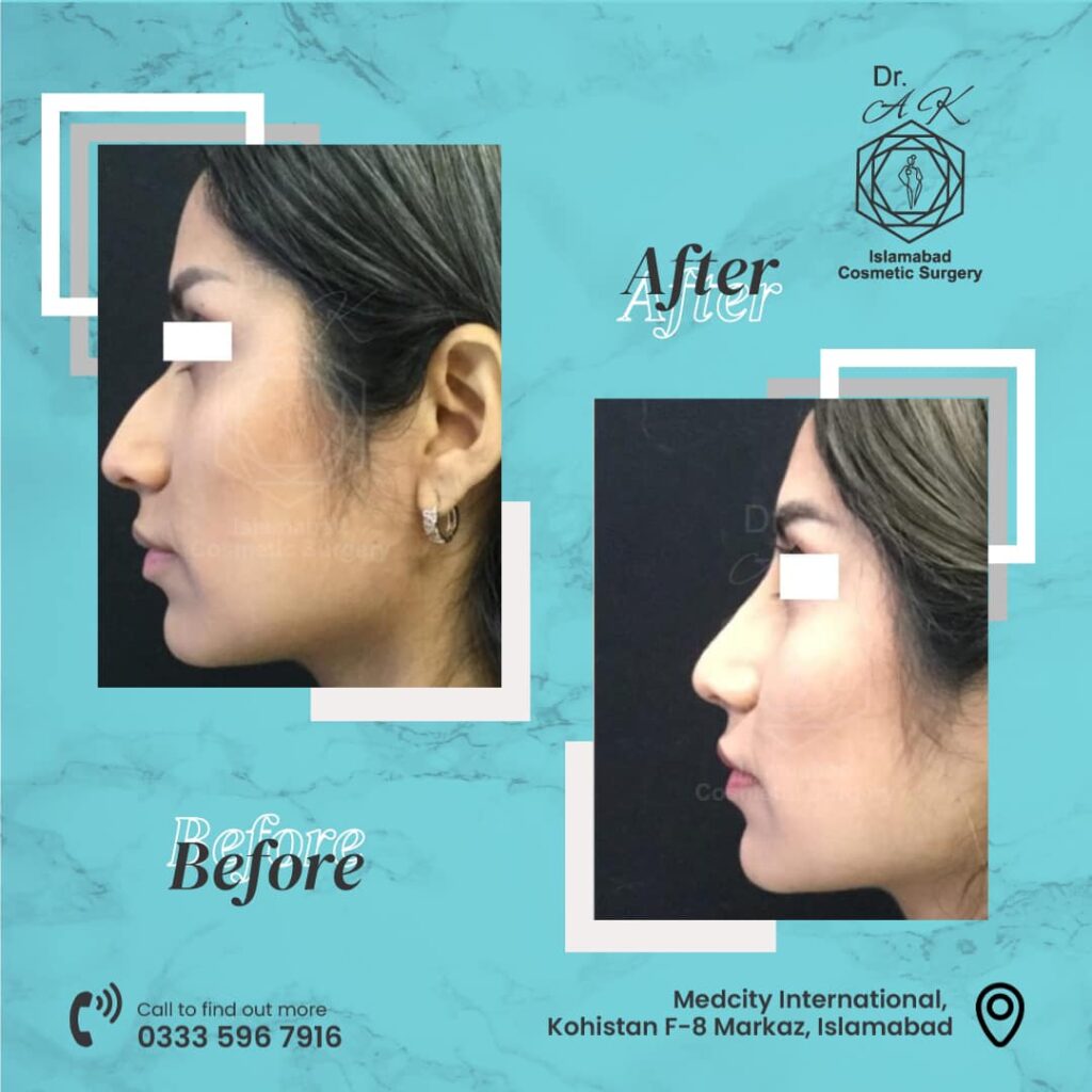 nose surgery in islamabad