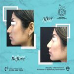 nose surgery in islamabad