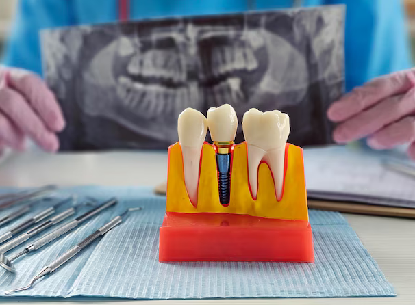 same day implants bowling green ky