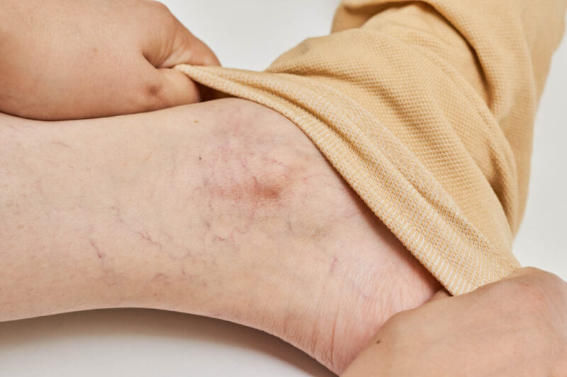 كم مرة يحتاج علاج الدوالي؟