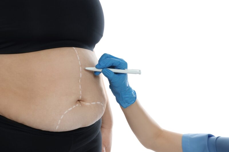 كيف تُعيد عملية شد البطن تشكيل محيط خصرك؟