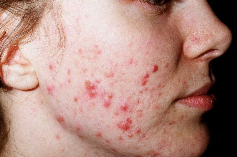 كيف يُحسّن علاج ندبات حب الشباب بالليزر البشرة؟