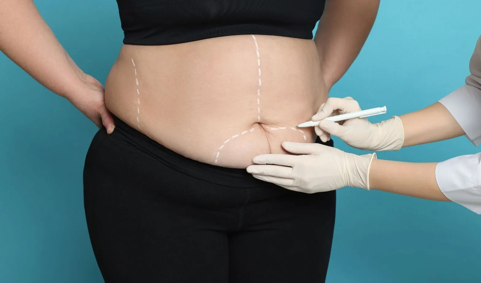 ما المناطق التي يُمكن علاجها بأمان باستخدام شفط الدهون بالليزر؟