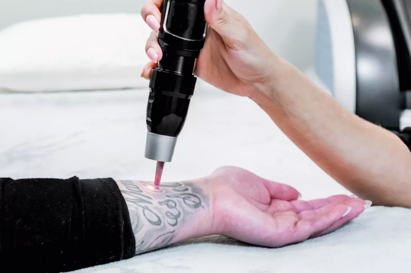 ما مدى فعالية إزالة الوشم بالليزر مع الوشوم القديمة؟