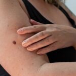 ما هي أفضل طرق إزالة آفات الجلد؟