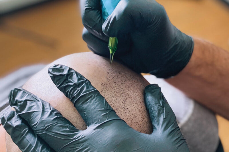 هل التصبغ المجهري لفروة الرأس حل دائم؟