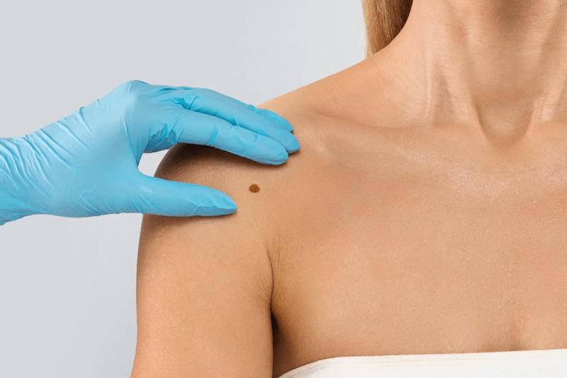 هل تتطلب إزالة آفات الجلد جلسات متعددة؟