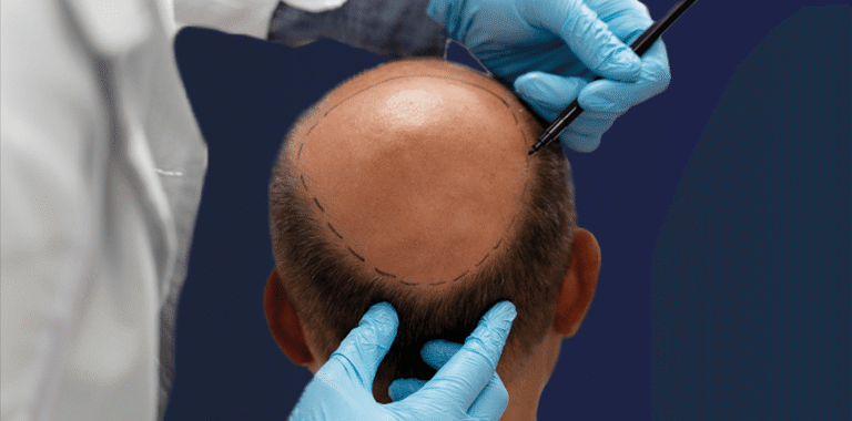 هل تُعطي زراعة الشعر في منطقة التاج نتائج دائمة؟