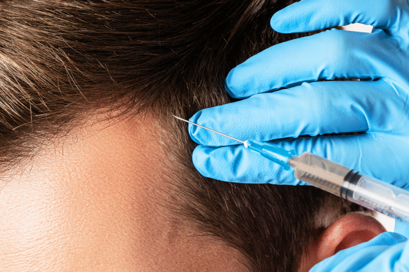 هل يُعيد علاج ACell PRP لتساقط الشعر إنبات الشعر؟