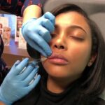 Russian Lip Fillers in Dubai