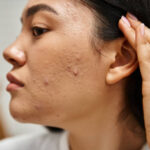 Can Acne Treatment Remove Acne Scars Fast