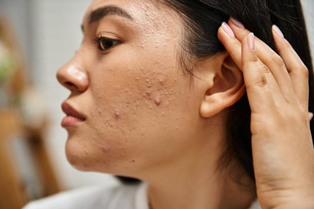 Can Acne Treatment Remove Acne Scars Fast