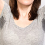 Hyperhidrosis Treatment in Dubai