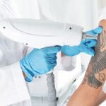 Laser Tattoo Removal in Dubai