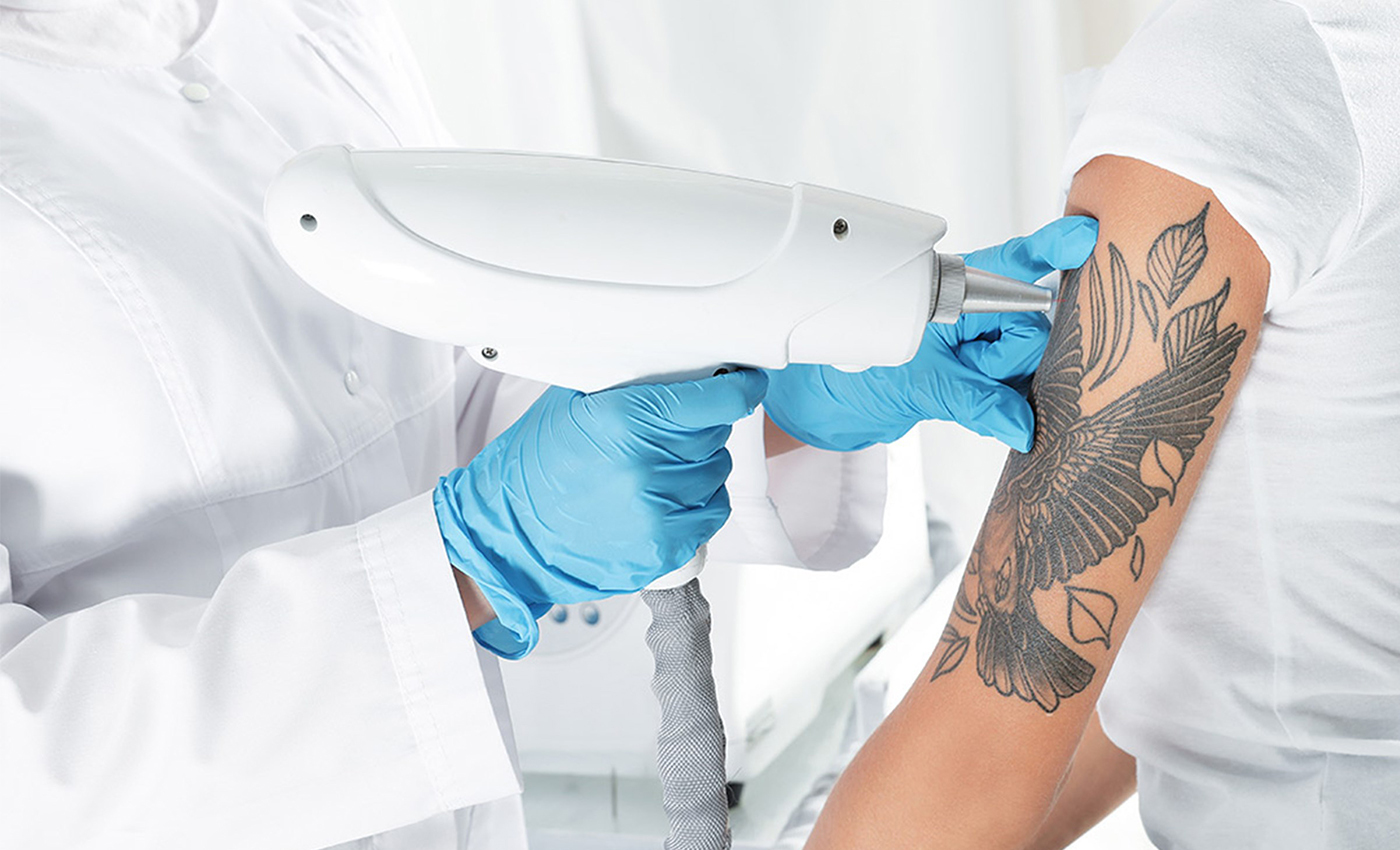 Laser Tattoo Removal in Dubai