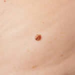 Does Mole Removal Work for All Skin Types and Ages