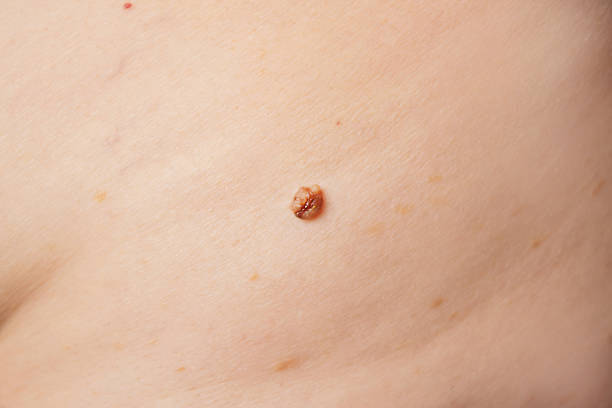 Does Mole Removal Work for All Skin Types and Ages