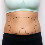 Does Tummy Tuck Tighten Abdominal Muscles