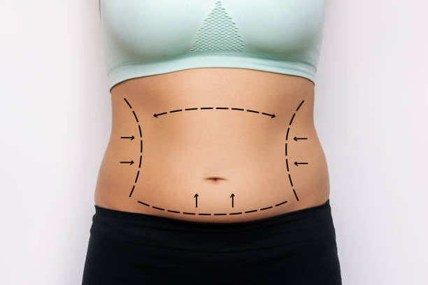 Does Tummy Tuck Tighten Abdominal Muscles
