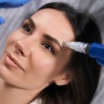 How Does Microneedling Brighten Dull Skin?