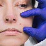 How Long Before You See Results From Mole Removal Treatments