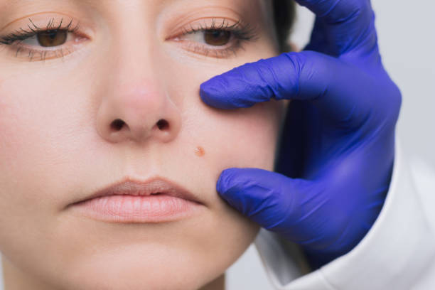 How Long Before You See Results From Mole Removal Treatments