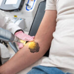 How Long Does Laser Tattoo Removal Take