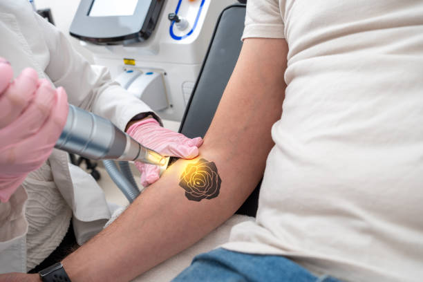 How Long Does Laser Tattoo Removal Take
