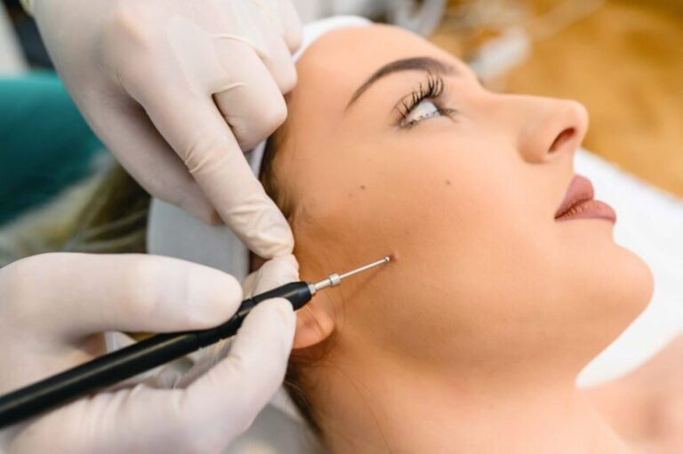 How Long Does Mole Removal Take to Heal?