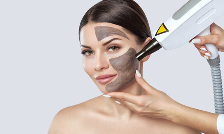 How Many Laser Carbon Peel Sessions Needed