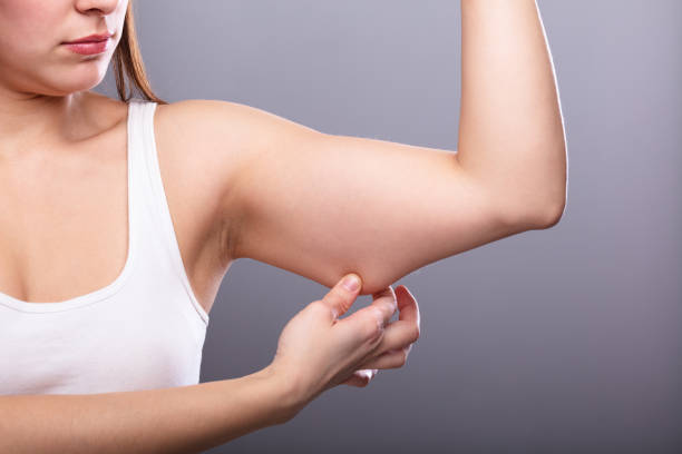 Is Arm Lift the Right Step for Better Arm Proportion