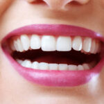 Is E-Max Veneers a Quick Fix for Smile Enhancement