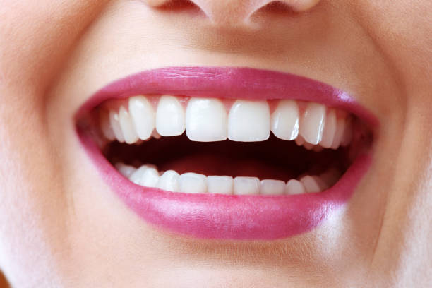 Is E-Max Veneers a Quick Fix for Smile Enhancement