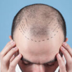 Is FUE Hair Transplant Good for Receding Hairlines
