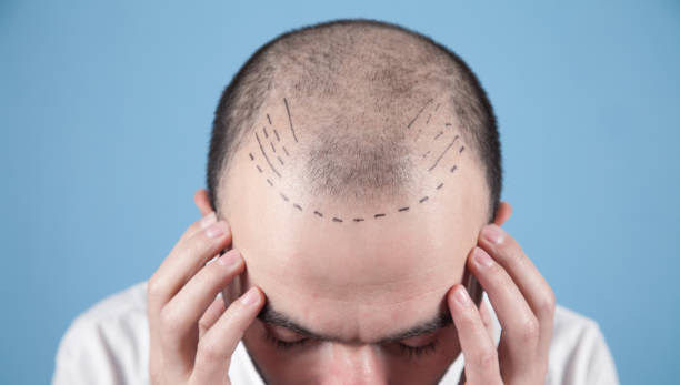Is FUE Hair Transplant Good for Receding Hairlines