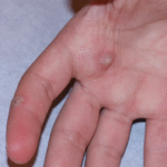 Is Warts Removal Treatment Better Than Home Remedies