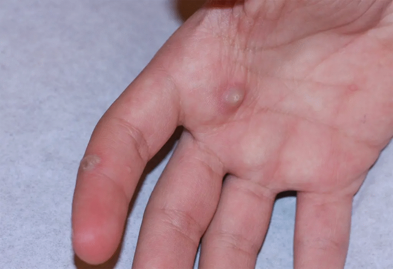 Is Warts Removal Treatment Better Than Home Remedies