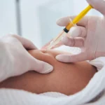 Quick and Painless Fat Reduction