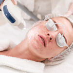 Renew Your Skin with Laser Acne Scar Therapy