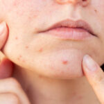 What Acne Treatment Ingredients Work Best for Skin