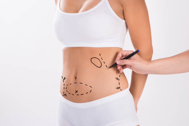 What Liposuction Procedure Delivers the Best Results