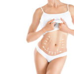 What Makes You a Good Candidate for a Tummy Tuck