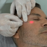 ما مدى أمان إندوليفت لتجديد البشرة؟