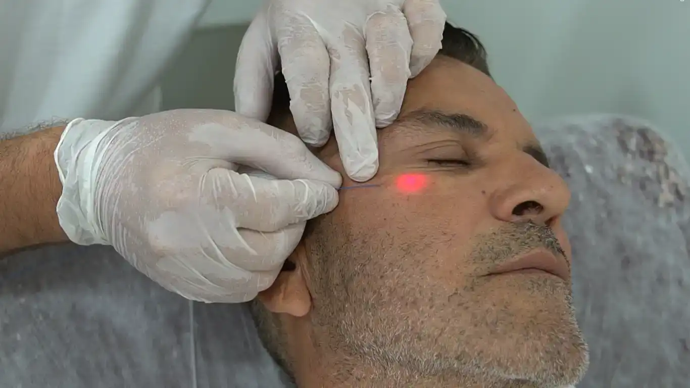 ما مدى أمان إندوليفت لتجديد البشرة؟